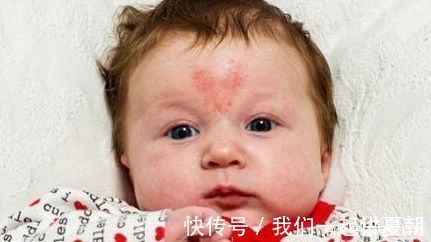 怀孕期间|不想宝宝长胎记？妈妈怀孕期间要尽量避免这4件事