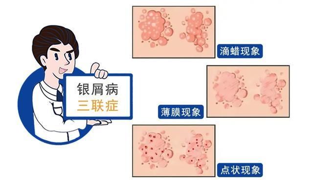 患者|重要通知：银屑病（牛皮癣）防治补贴，专家联合会诊就在本周