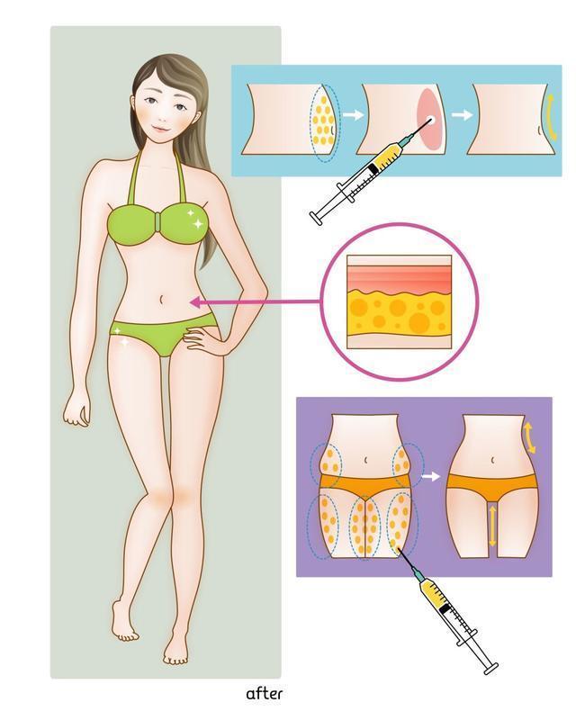原理 吸脂手术原理是什么？直击腹部吸脂手术全过程