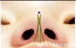 蛋白线|看完这个，你还敢做线雕隆鼻吗？