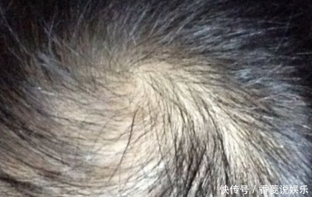头上出现4个变化，是螨虫已爬入毛囊征兆，很多人不知晓