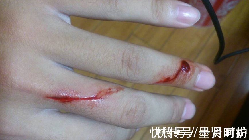 手指|三岁女童被活活截断手指,终生残疾!只因用错创可贴,快自查