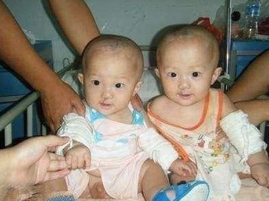 双胞胎|孕妇怀双胞胎查出唇腭裂,坚持生下后,一家人乐开了花