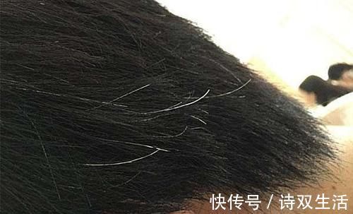 答案|长白头发的人,比正常人的患癌风险低,是真的吗医生告诉你答案