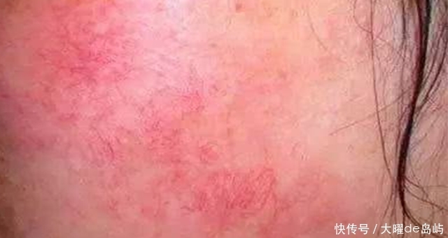 我成了激素脸,用什么护肤品都过敏,怎么办?急死我了!