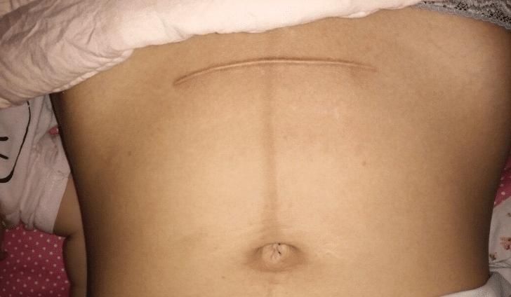 剖腹产|剖腹产多会有3个“后遗症”,二胎宝妈尤为明显,要格外注意