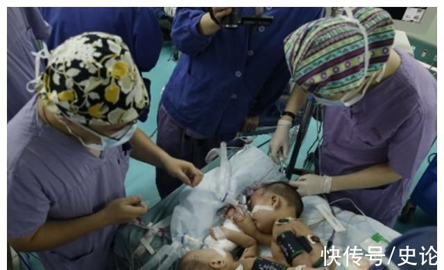 浙大儿童医院|22年前轰动一时的连体女婴，分离术后姐姐去世，妹妹如今结婚生子