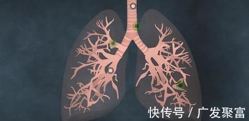 淋巴结|肺癌早期也是有迹可循的,身体出现这5个异常,还请及时就诊检查!