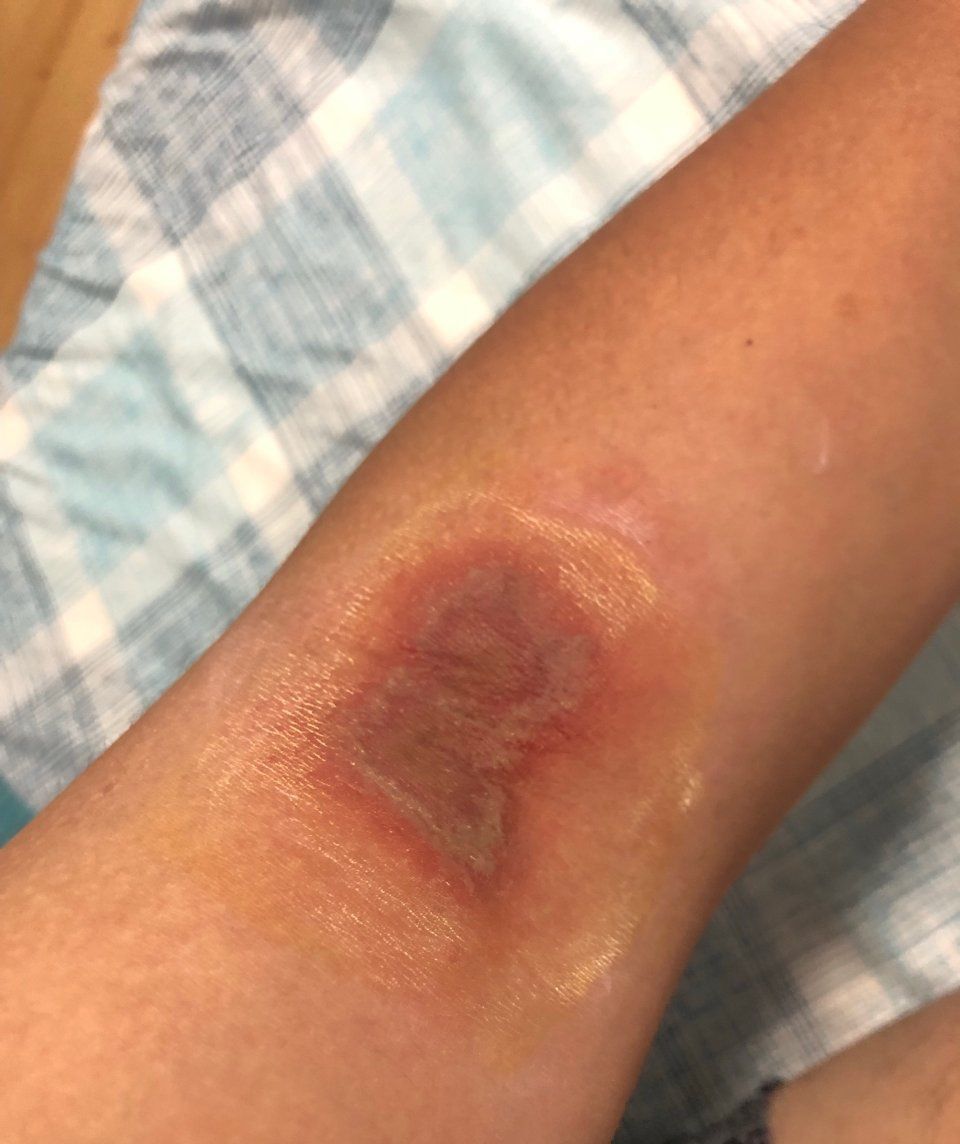 ph值|6岁男孩只因惹了这个小家伙脸部皮肤溃烂。麻烦就在“举手之间”