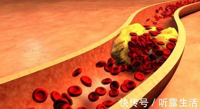 总胆固醇|高血脂的“死对头”已找到,3种水果没事多吃点,血管能一通到底