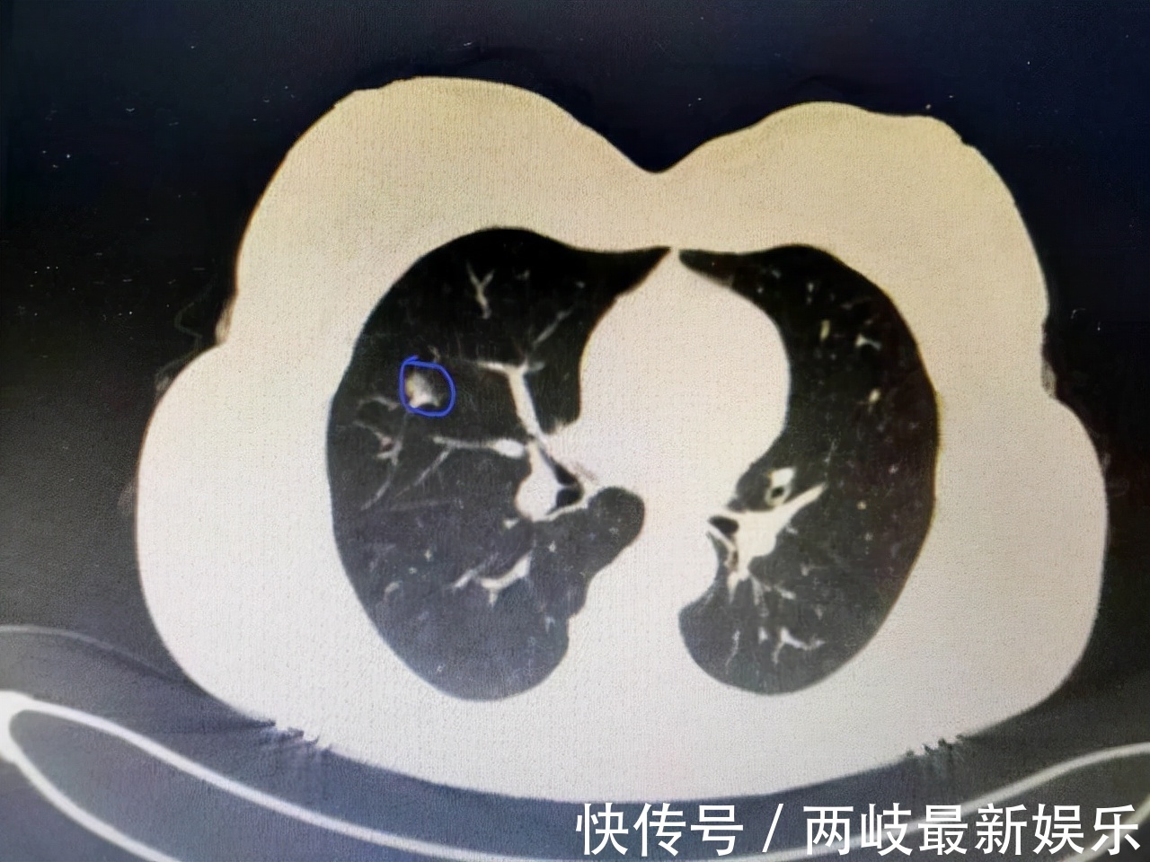 刘大姐|48岁女性被查出甲状腺癌，提醒“1蛋、3菜”要少碰，或保护甲功