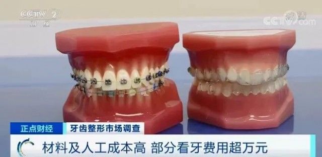 口腔|“整牙热”再次掀起：一颗牙要2万元，为啥这么贵？