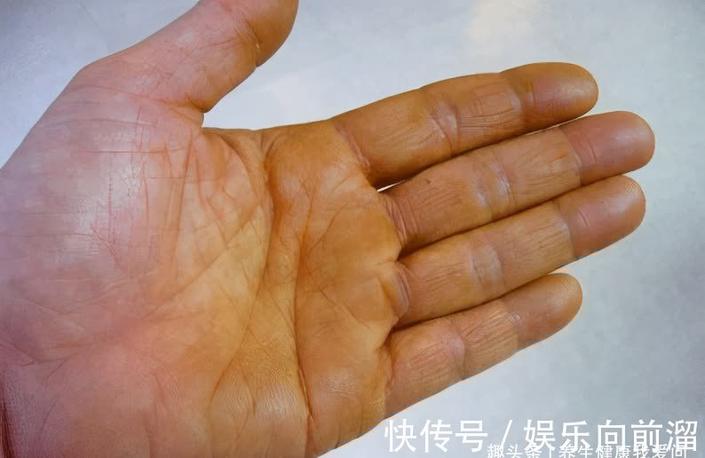 乙型肝炎|34岁确诊晚期肝硬化，从绝望到重生，我靠这一疗法战胜了它