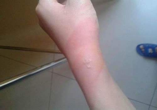 皮肤|突发情况意外烫伤怎么处理这几个应急方法都很管用