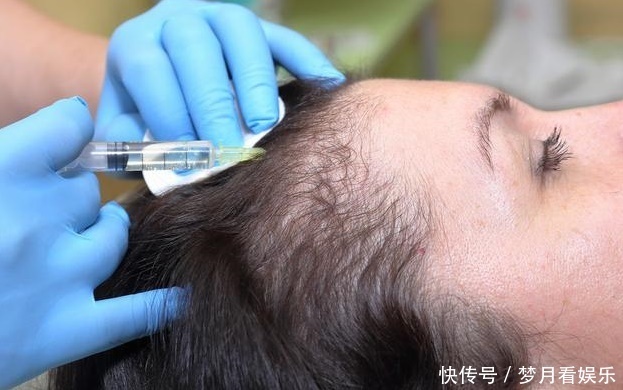 遇上传说中的“鬼剃头”,我们该如何去应对