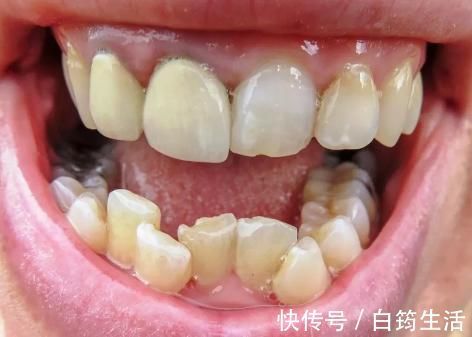 换牙|孩子换牙齿,新长的牙齿却是歪的,可能是家长这些没做好