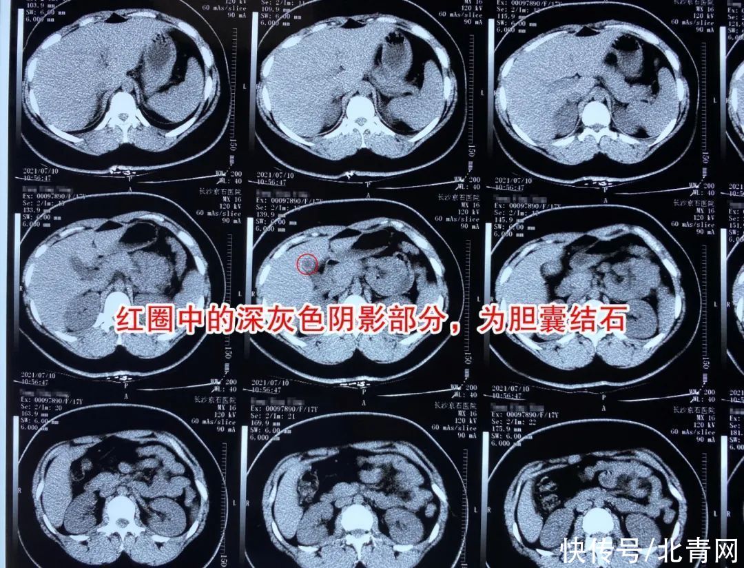 胆结石|学生胆结石群体暑期扎堆就诊，胆结石年轻化趋势或与这些因素有关