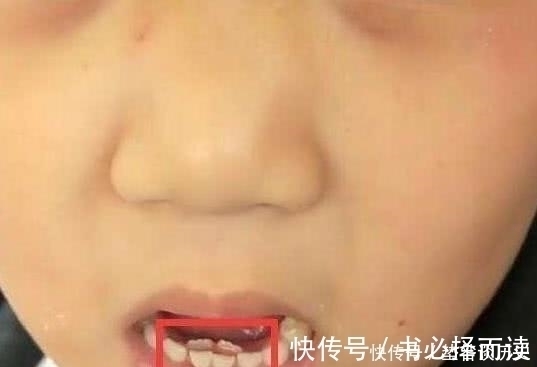 孙子|7岁孙子长出“双排牙”,每一颗都要拔,奶奶自责都是我的错