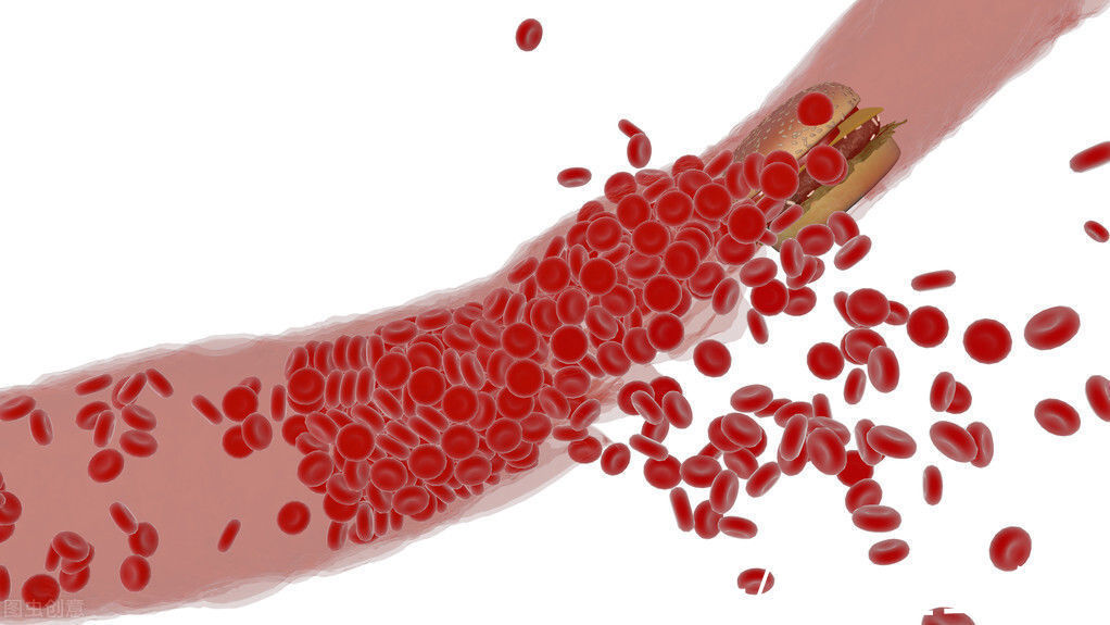 动脉|体内有个“不定时炸弹”？关于斑块的5个知识，建议提前了解一下