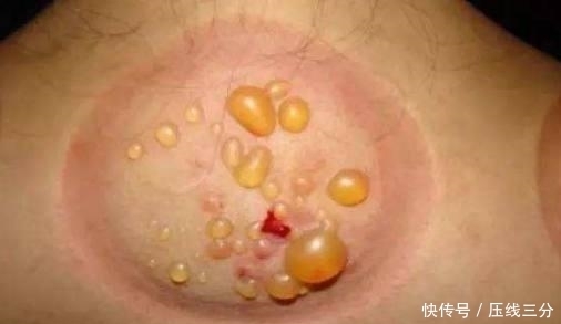 大肚腩|入夏湿气重,多吃这3种食物,告别湿气,消除大肚腩!