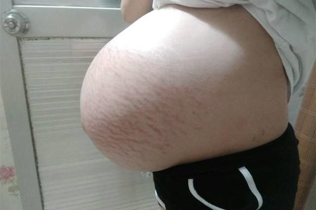 剖腹产|“悬浮肚”十产九剖,孕妈想要顺产,要满足这两个条件