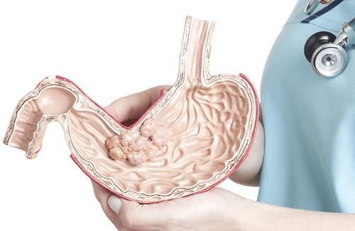 结肠癌|大肠癌的罪魁祸首已经找到，晨起坚持三个习惯，肠道才会更健康