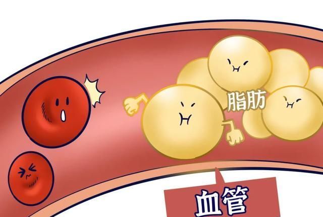 胆固醇|甘油三酯高的人注意,这5种食物再馋最好也不要碰,易升高血脂