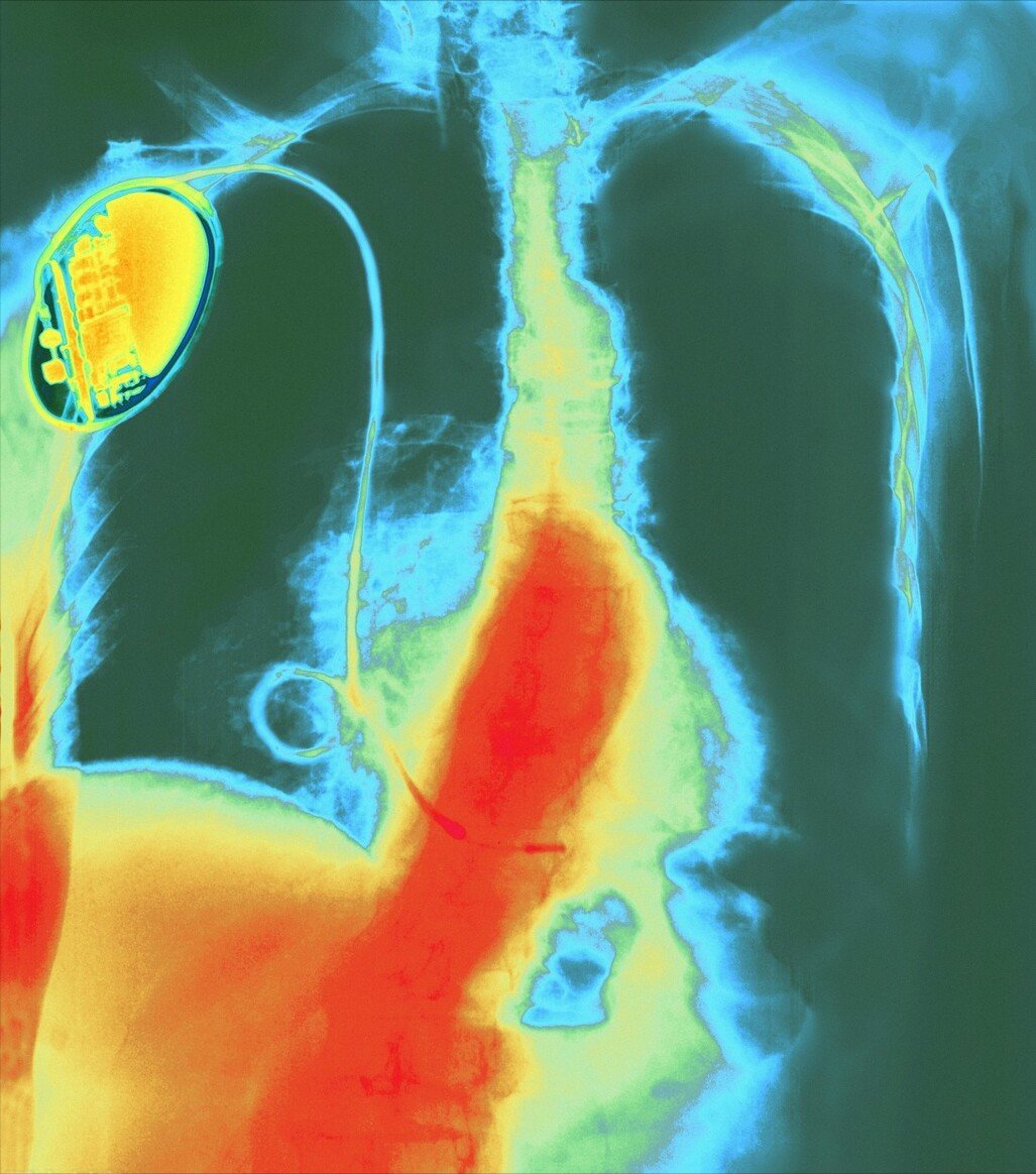 头晕乏|经常头晕乏力、气促胸闷，心率＜60，谨防严重心动过缓，可这样治