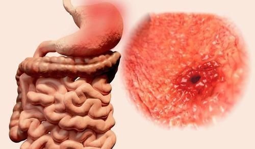 直肠癌|医生告诫早期直肠癌的4个异常“变化”,你一个都不能忽视
