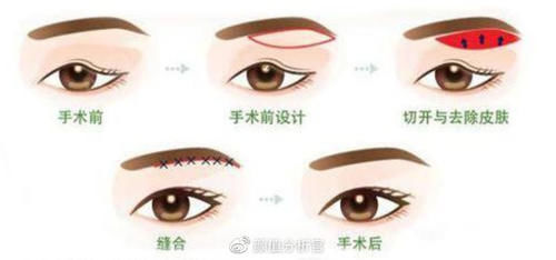 提眉可以改善上睑下垂的问题吗？