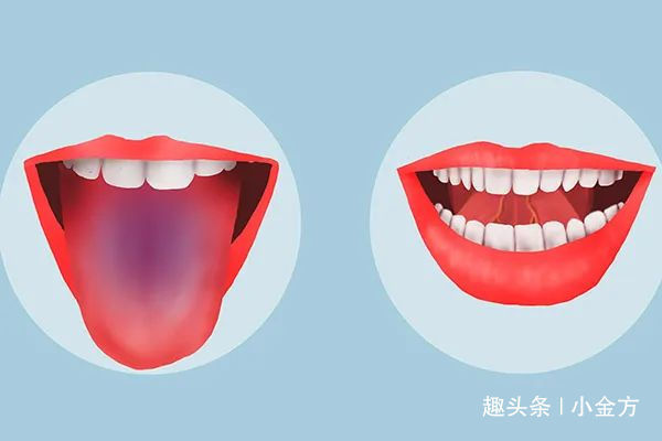 青筋凸起|舌下有青筋,到底是不是病真的暗示肝脏受损了吗