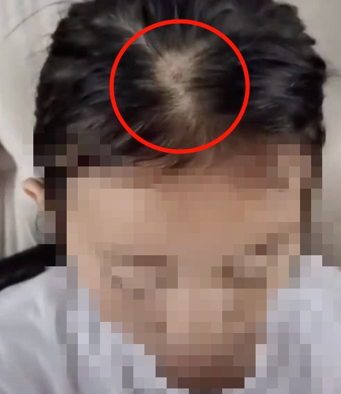 回家|带回家才几天,女儿头顶“秃”了!妈妈崩溃:我悔啊...