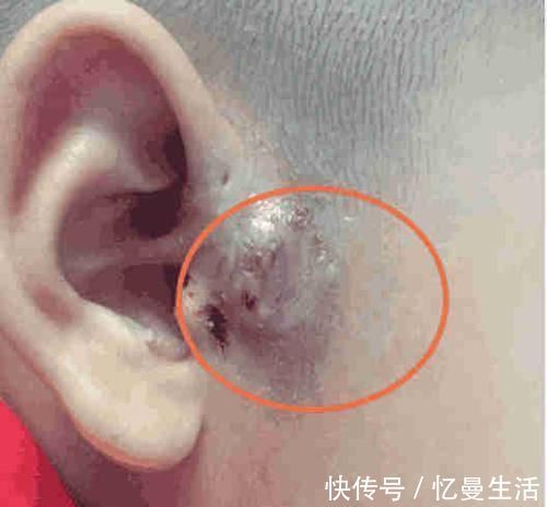 宝宝|如果宝宝耳朵上有这种小孔, 就要小心了, 千万别碰