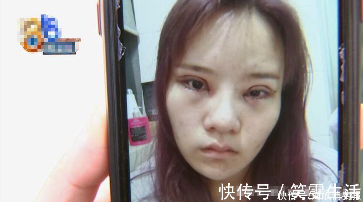 手术|女子花3万多割双眼皮,术后还没以前好看,医生:可以修复