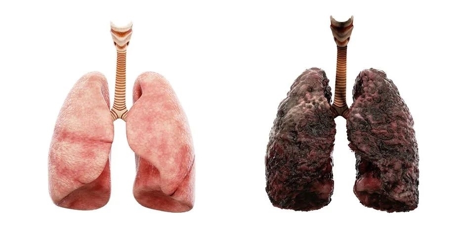 肺癌早期静悄悄?发现早期肺癌,这个方法一定要知道