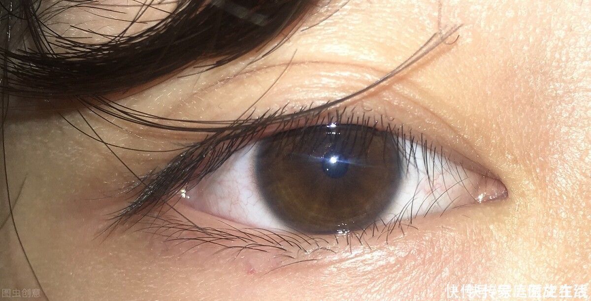 双眼皮|双眼皮手术后疤痕增生是怎么了?做好3件事,可帮你预防