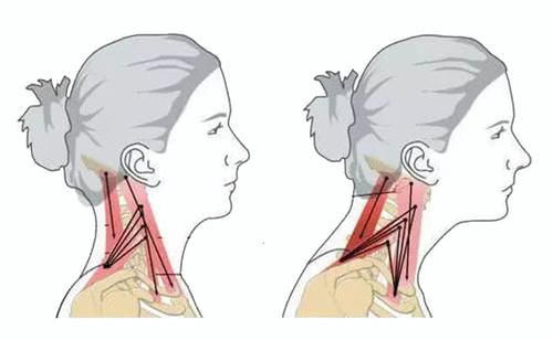 筋膜|颈椎病、富贵包、头痛手麻，都因为这个姿势！如何预防？