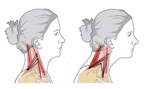 筋膜|颈椎病、富贵包、头痛手麻,都因为这个姿势!如何预防?