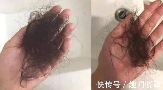 截肢|2个月宝宝险被截肢,每小时放一次血!凶手竟是妈妈一根头发