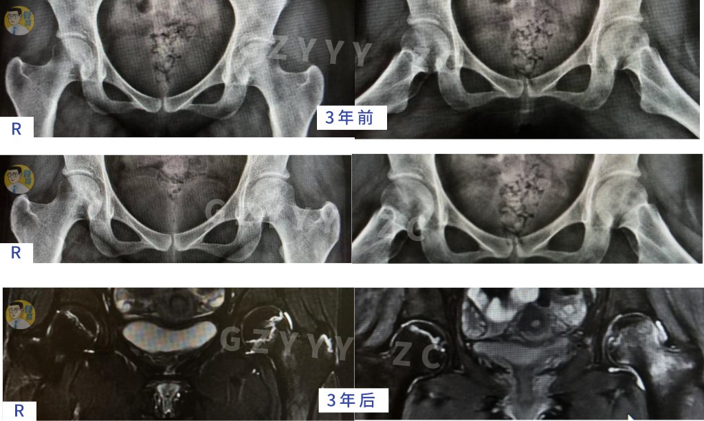 手术|看准、选对、做好——股骨头坏死保髋就这样成功了？