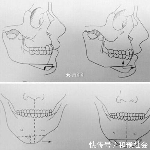 成形术|颏成型术和假体垫下巴有啥区别？下巴短还后缩做哪个好？