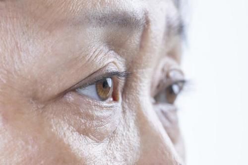 内切法|眼袋堪称“年龄播报机”!年过50岁之后,这个手术可以去除