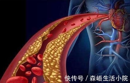 医生|一小伙体检血脂正常，竟心梗发作离世，医生：体检指标正常≠血脂正常