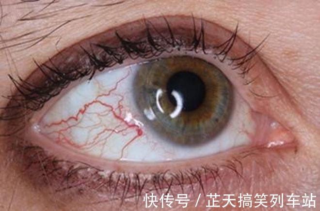 发黄|肝是“哑巴”,如何判断肝好不好?若有这5体征,抽空去趟肿瘤科