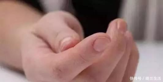 手指肚|大拇指上暗藏的中风信号，一旦出现赶紧就医
