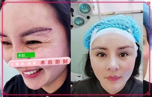 显美眼袋手术恢复期要多久,做眼袋手术后吃什么好处多?