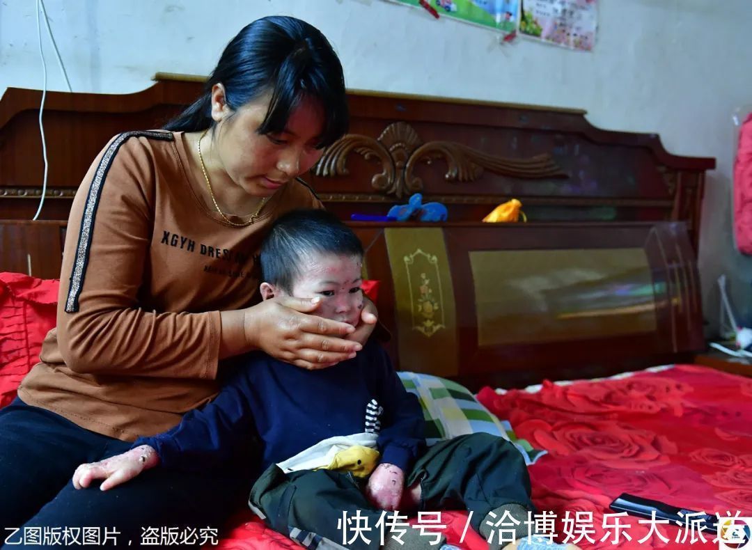 纱布|男童出生患罕见病,三年用掉纱布5000多圈,每天只能坐在床上