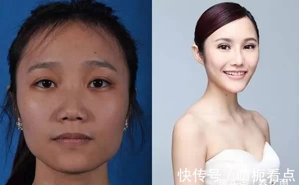 美白|实拍：10张女孩整容前后的对比照，这真就是换了一张脸