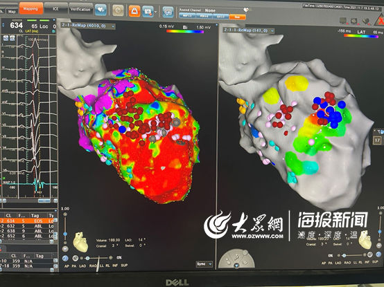 器质性|当心脏“电风暴”遭遇暴风雪，山东首例器质性室速射频消融术逆天改命