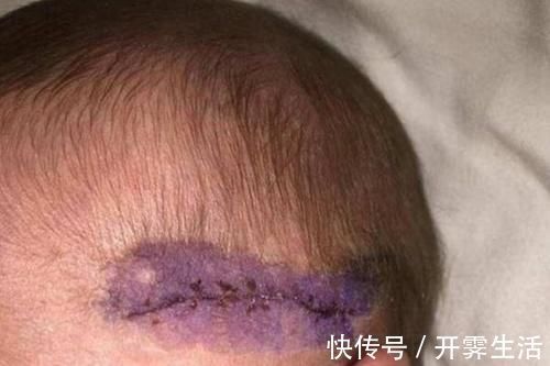 顺产|剖腹产划伤宝宝,宝妈声讨无果,若想避免,准妈妈要注意这几点
